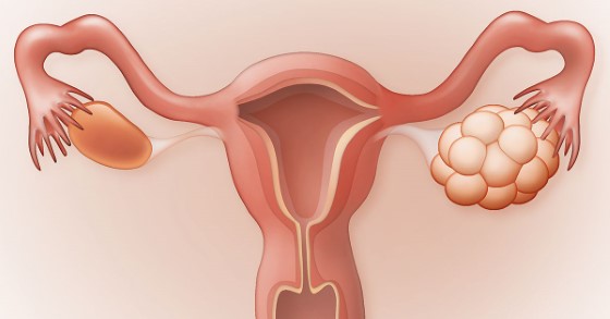 PCOS postihuje primárně ženy, přičmež v mnoha případech může vést až k částečné či úplné neplodnosti. Jak by mohlo pomoci CBD